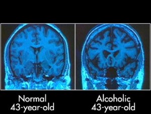 Alcohols impact on the brain